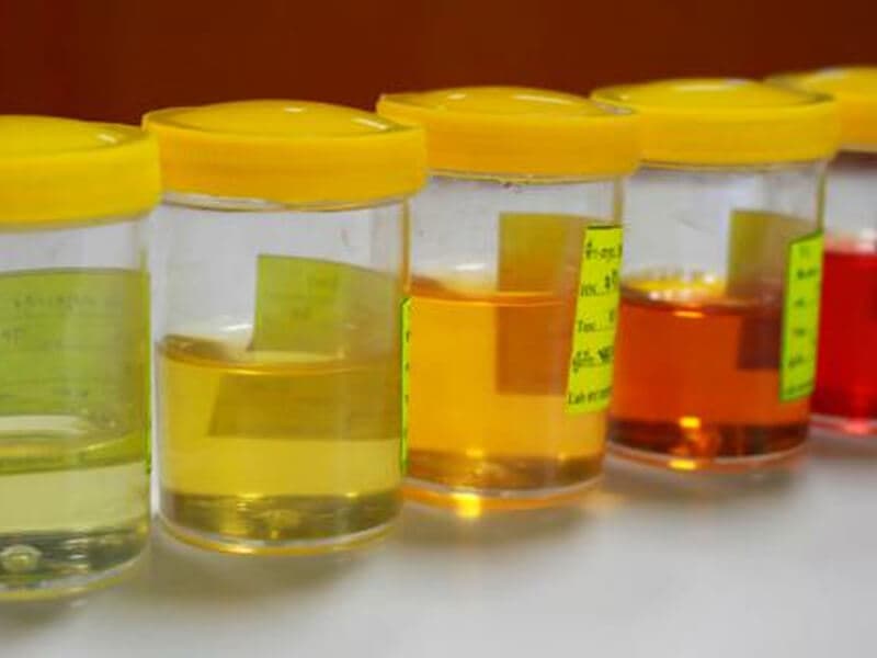 Sangre en orina / dolor lumbar